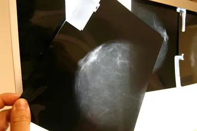 Las alteraciones del c&aacute;ncer de mama metast&aacute;sico, hacia la biopsia l&iacute;quida
